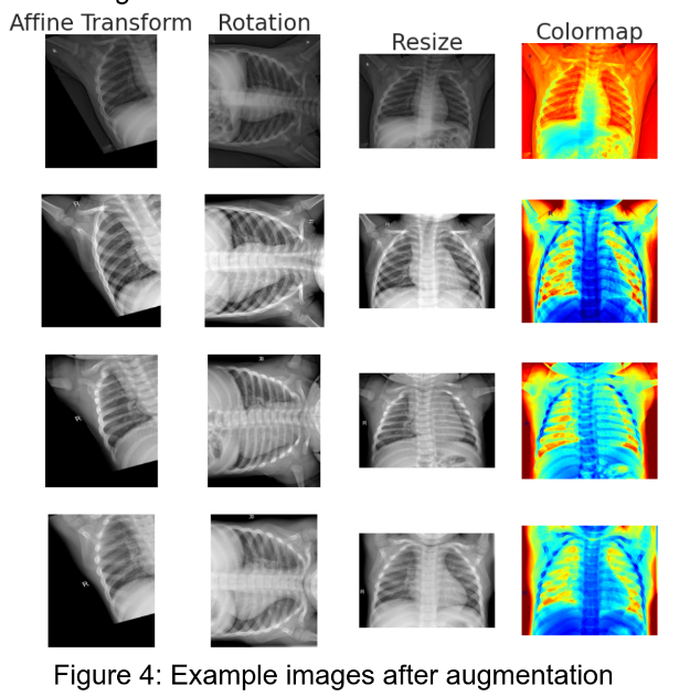 Pneumonia Detection from Chest X-Rays